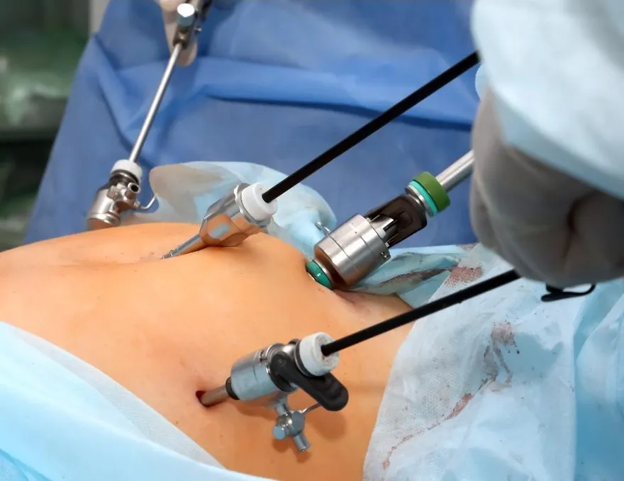 Laparoscopic (key-hole) surgery in progress